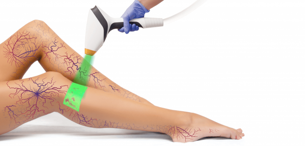Кріолазерна склеротерапію CLaCS: як проходить процедура і кому вона підходить?