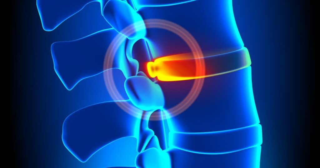 Что делать при грыже поясничного отдела?