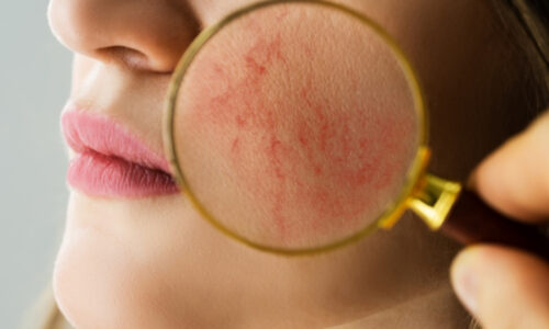 Как убрать сосудистые звездочки на ногах?