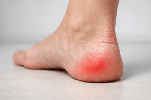 Как лечить пяточную шпору дома и в клинике?