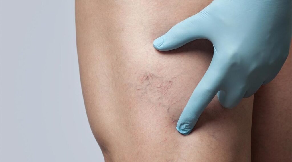 Как убрать сосудистые звездочки на ногах?