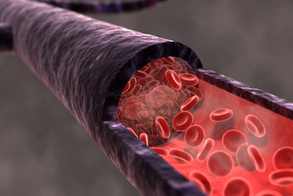 Чем опасен варикоз, если его не лечить?