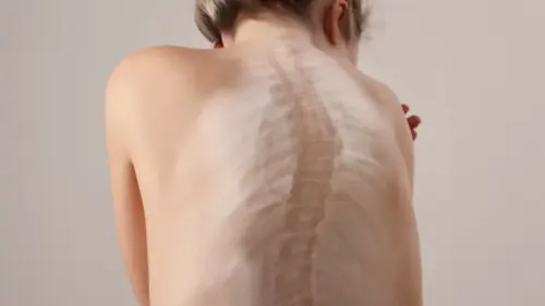 Как лечить сколиоз у детей?