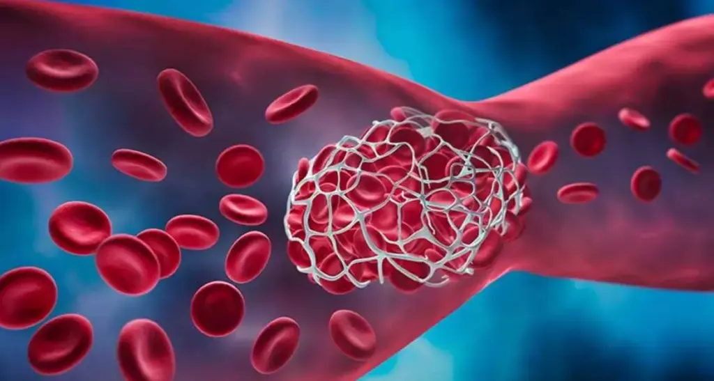 Тромбоз вен: какие признаки и что делать?